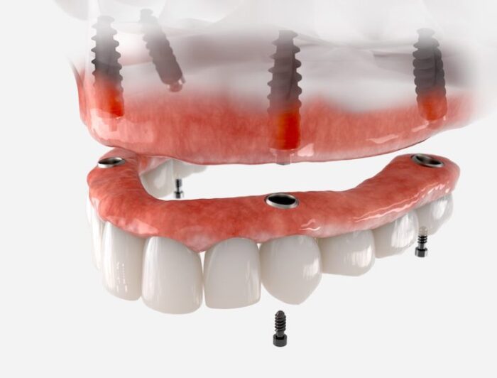 Immediate dentures could help maintain your appearance and oral function without having to wait after getting implants.